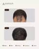 Slider image (8) Anagen - Hair Transplant Clinic in Switzerland